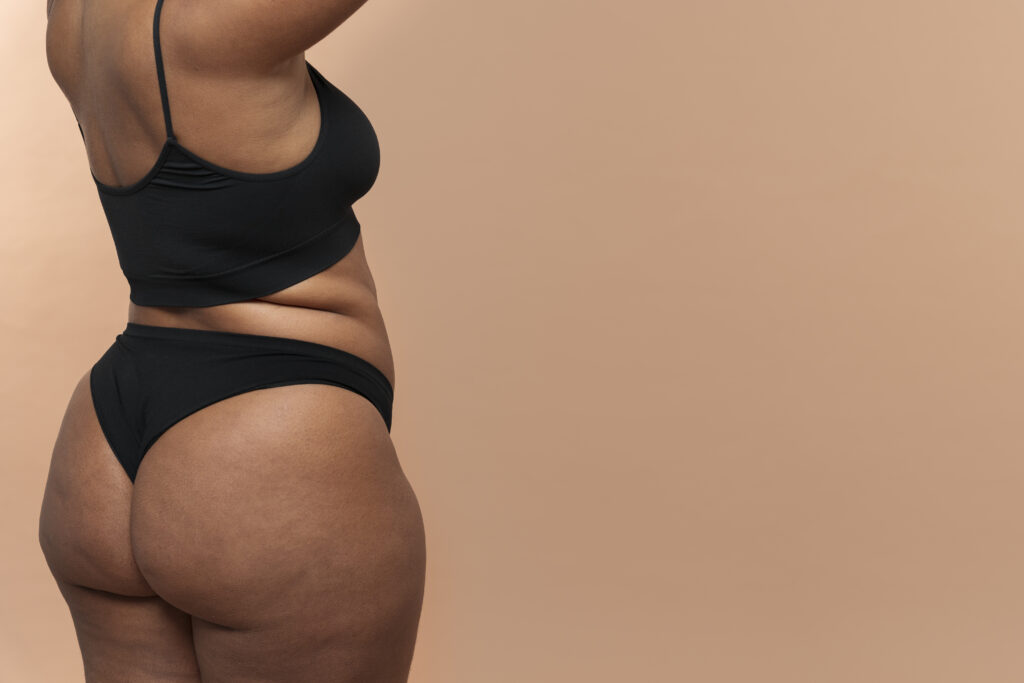 lipedema-inchaço nas pernas